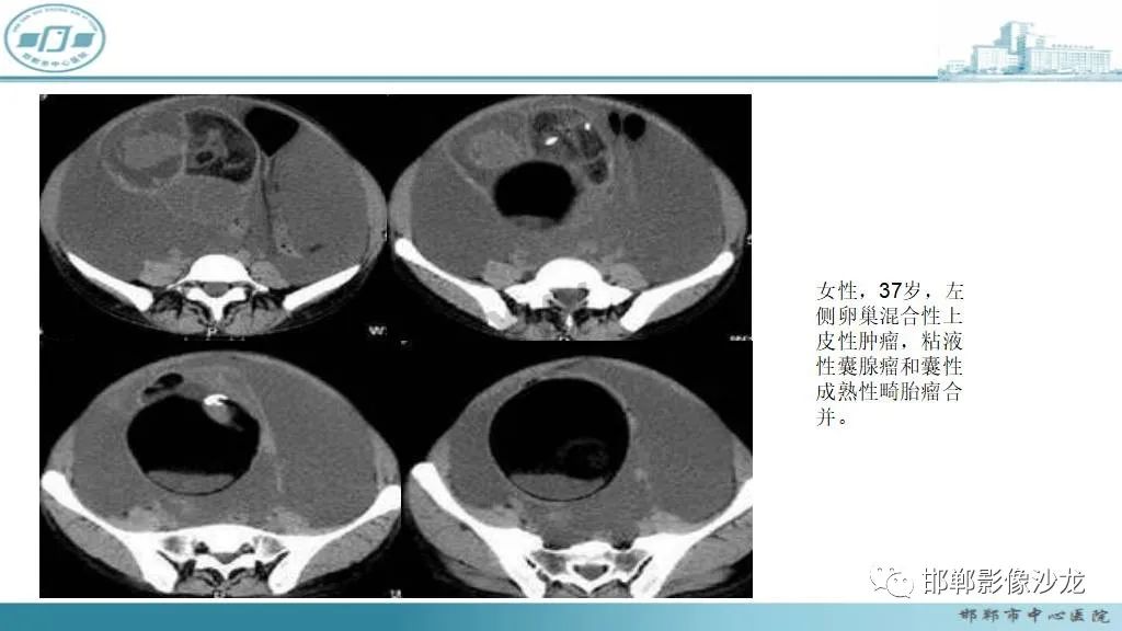 【病例】卵巢甲状腺肿1例CT影像-38