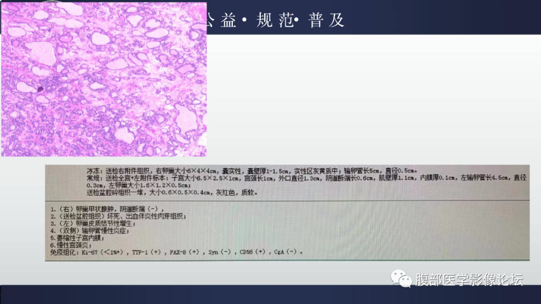 【病例】卵巢甲状腺肿1例CT影像-7