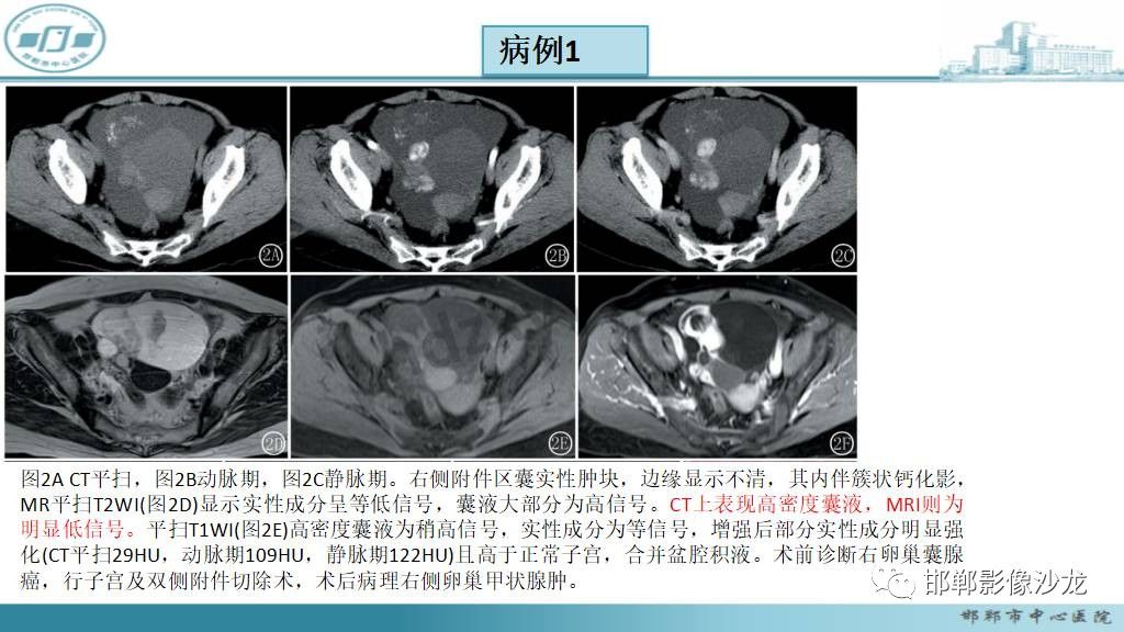 【病例】卵巢甲状腺肿1例CT影像-16