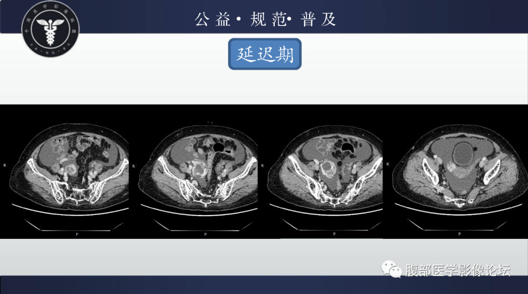 【病例】卵巢甲状腺肿1例CT影像-6