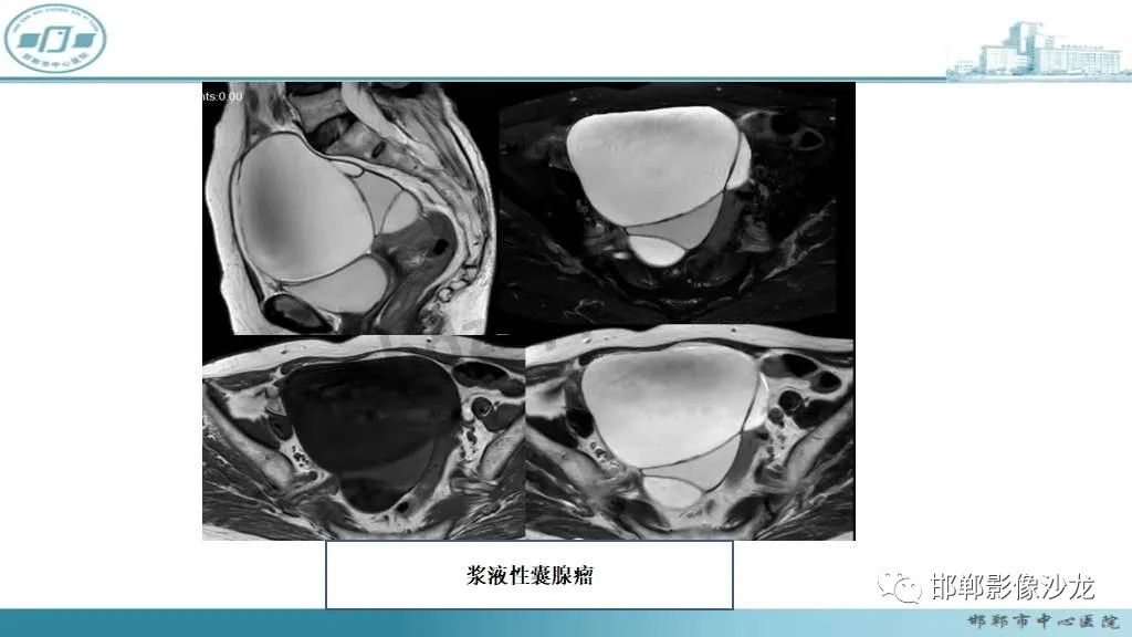 【病例】卵巢甲状腺肿1例CT影像-25