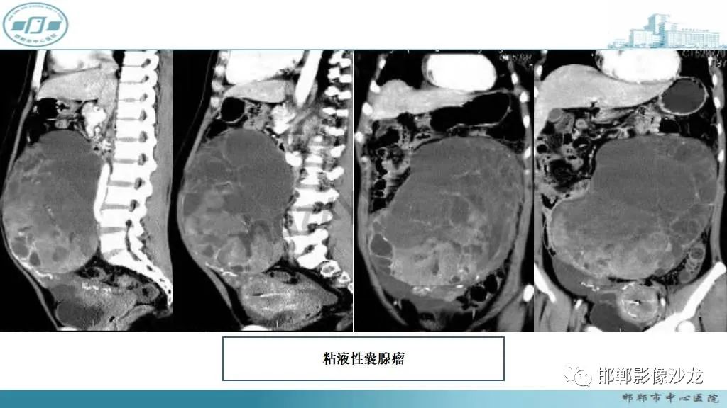 【病例】卵巢甲状腺肿1例CT影像-26