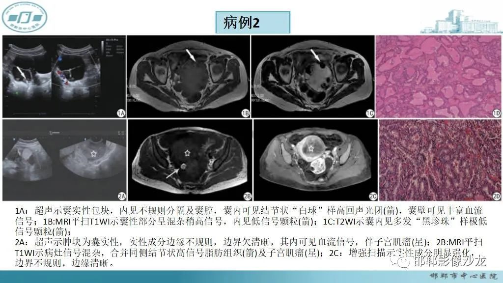 【病例】卵巢甲状腺肿1例CT影像-17