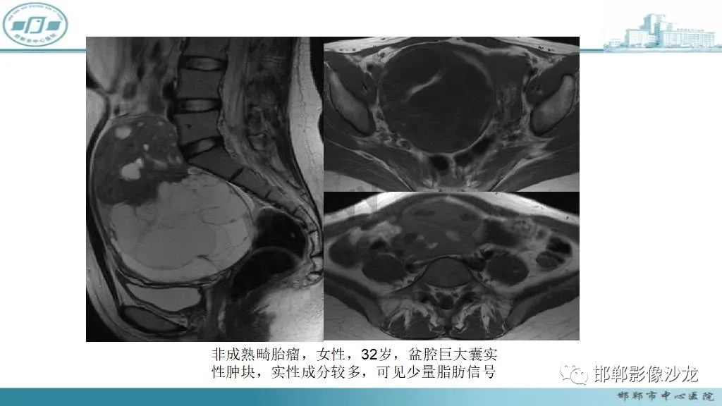 【病例】卵巢甲状腺肿1例CT影像-22