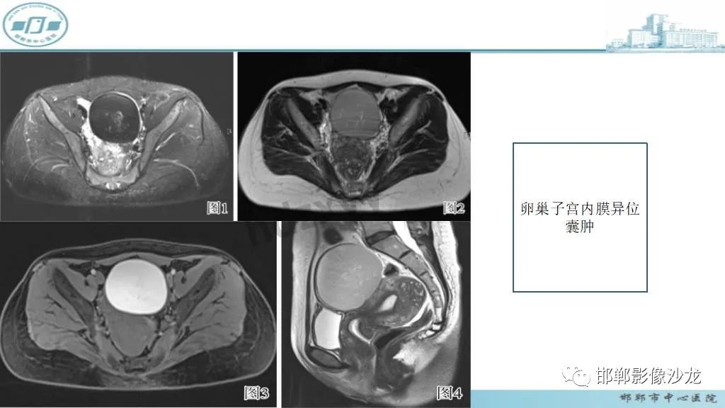 【病例】卵巢甲状腺肿1例CT影像-32