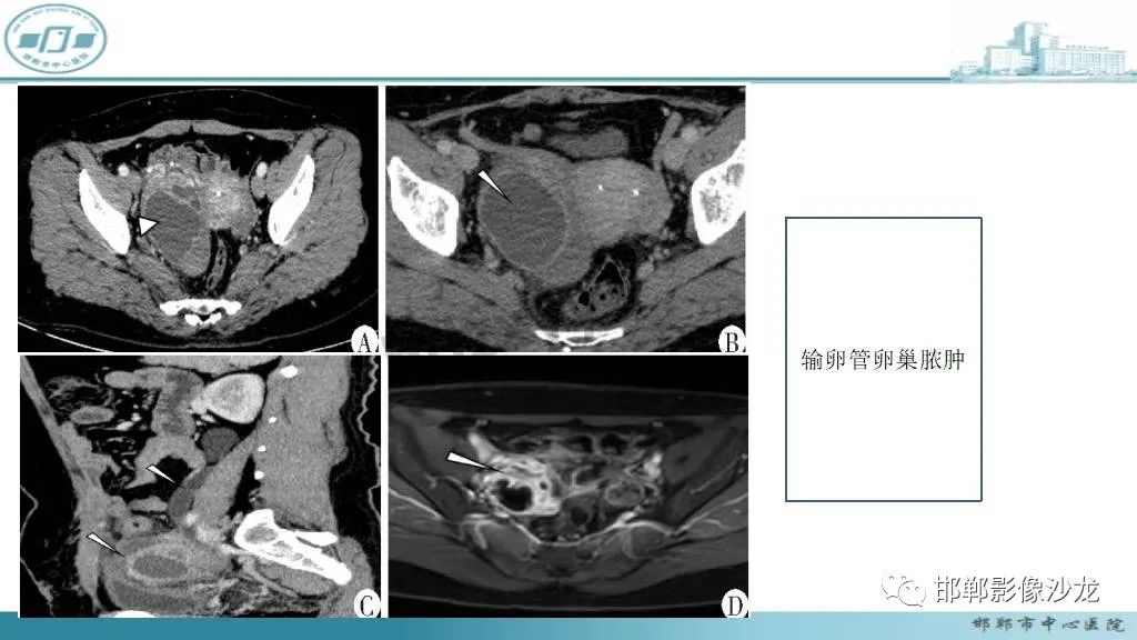 【病例】卵巢甲状腺肿1例CT影像-35