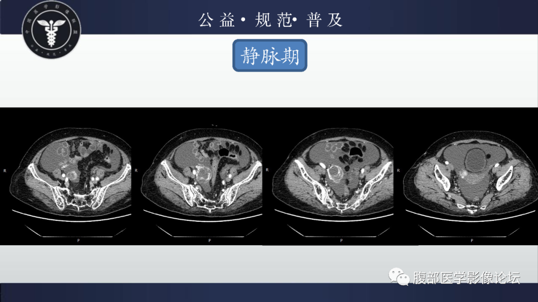 【病例】卵巢甲状腺肿1例CT影像-5