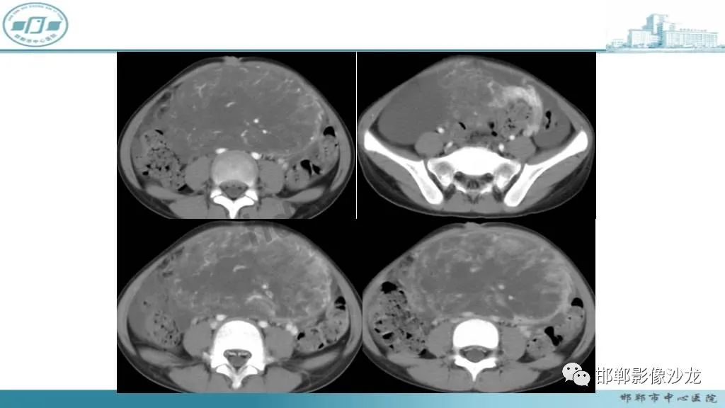 【病例】卵巢甲状腺肿1例CT影像-28