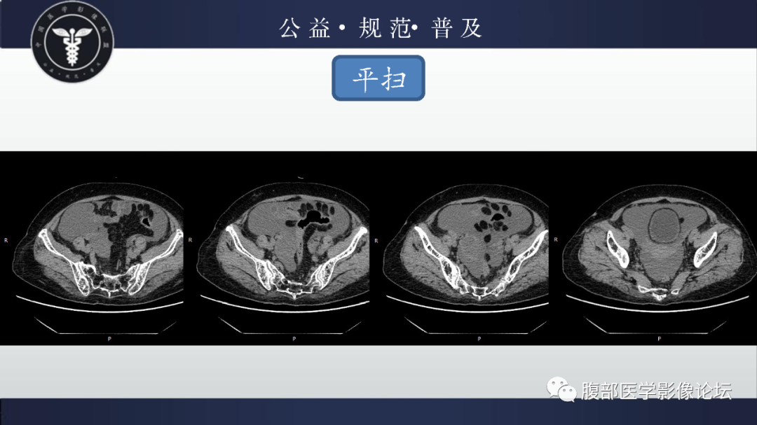 【病例】卵巢甲状腺肿1例CT影像-4