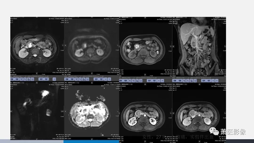 【PPT】常见胰腺囊性肿瘤-29