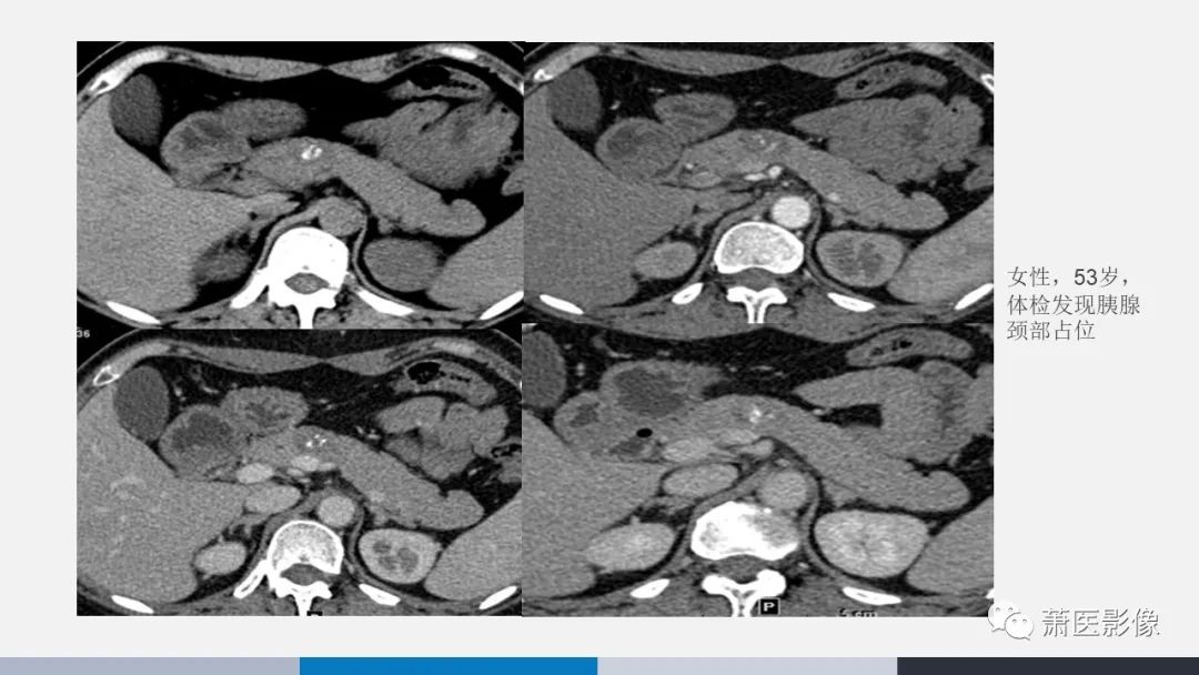 【PPT】常见胰腺囊性肿瘤-30