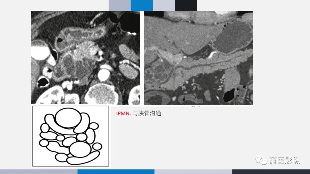 【PPT】常见胰腺囊性肿瘤-25