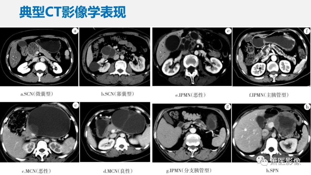 【PPT】常见胰腺囊性肿瘤-35