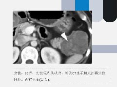 常见胰腺囊性肿瘤