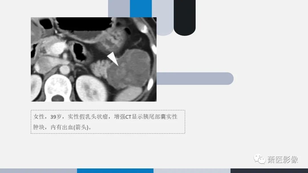 【PPT】常见胰腺囊性肿瘤-32