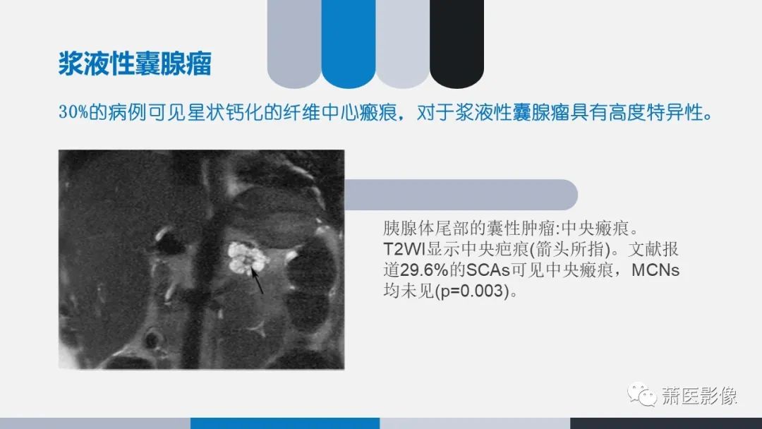 【PPT】常见胰腺囊性肿瘤-6