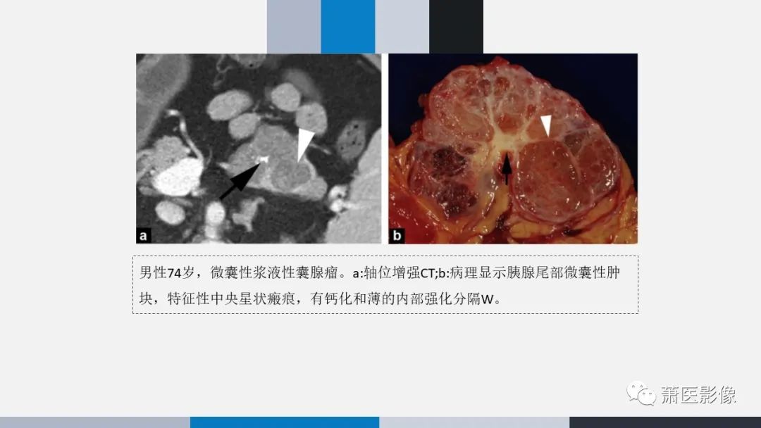 【PPT】常见胰腺囊性肿瘤-7