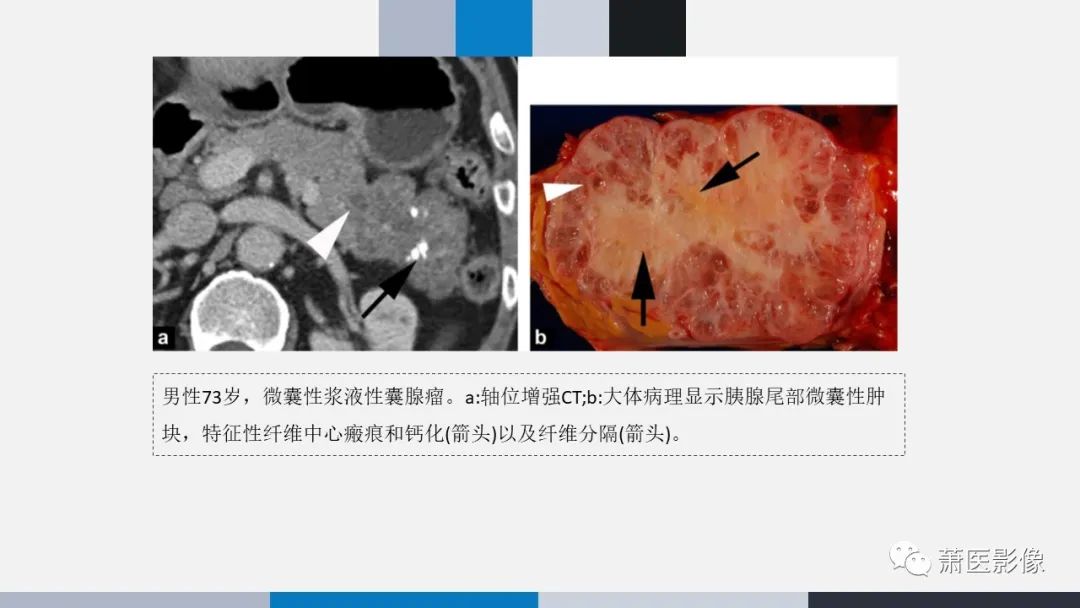 【PPT】常见胰腺囊性肿瘤-8