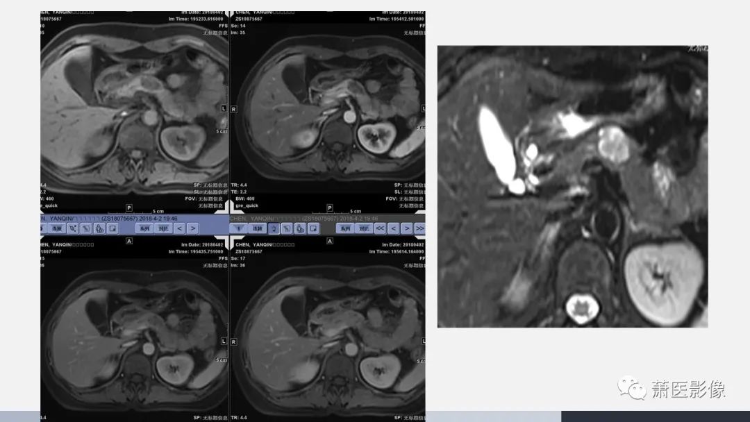 【PPT】常见胰腺囊性肿瘤-31