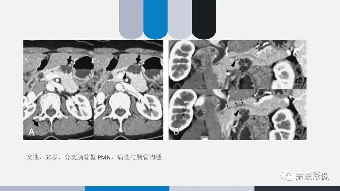 【PPT】常见胰腺囊性肿瘤-23