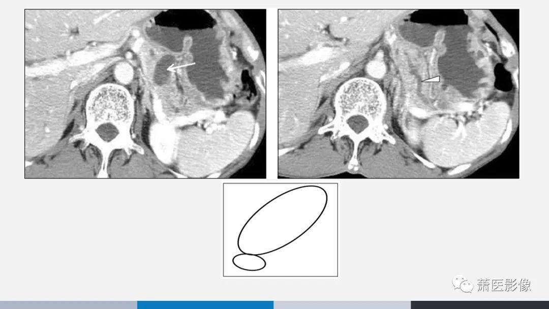 【PPT】常见胰腺囊性肿瘤-26