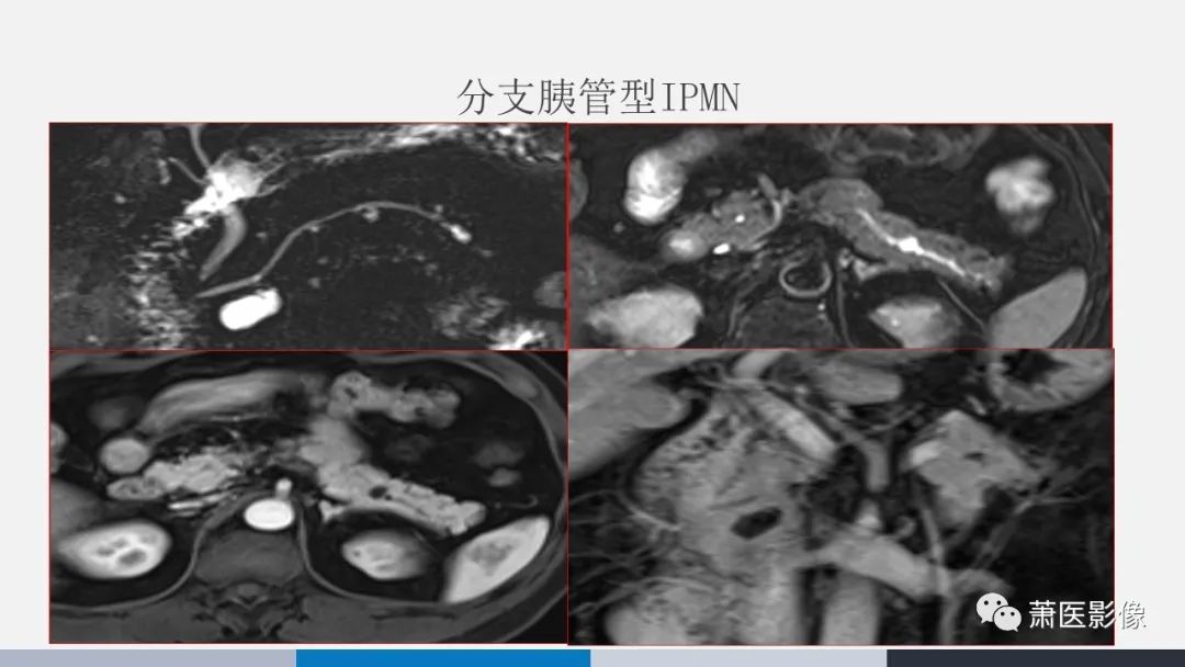 【PPT】常见胰腺囊性肿瘤-22