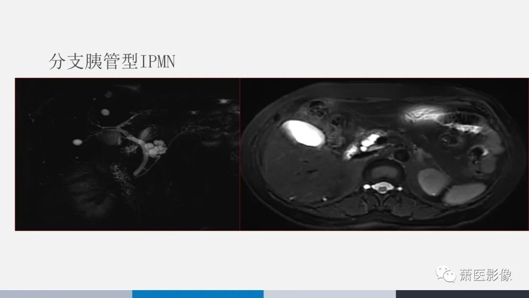 【PPT】常见胰腺囊性肿瘤-21