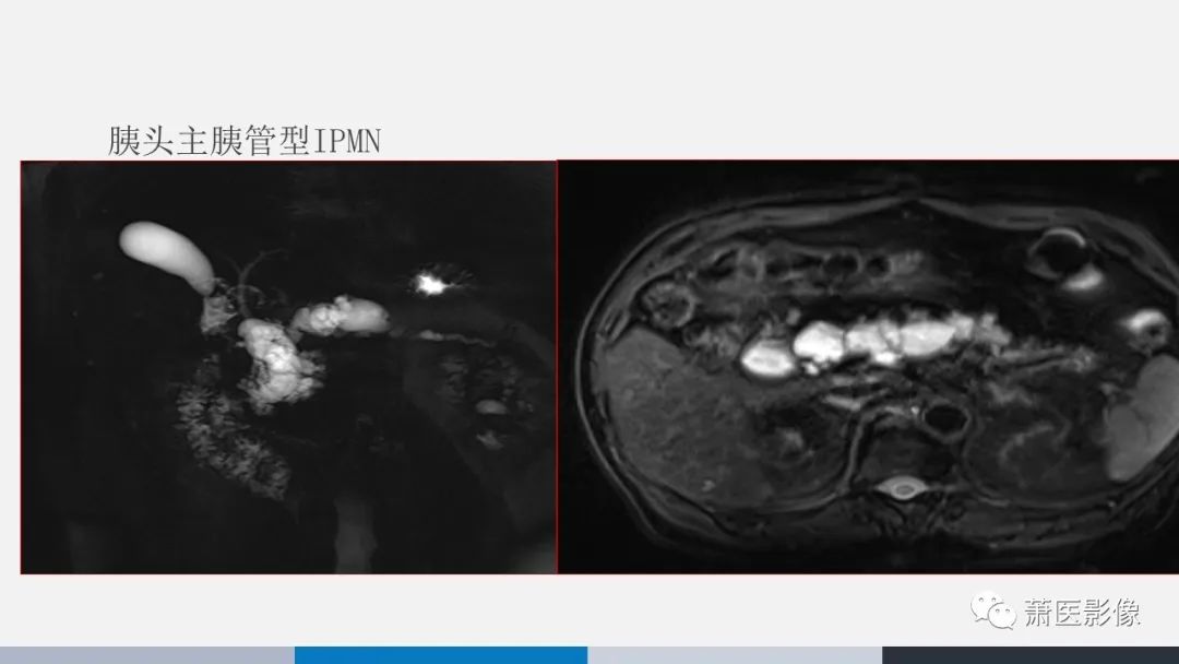 【PPT】常见胰腺囊性肿瘤-20