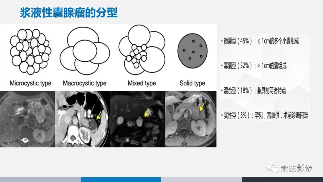 【PPT】常见胰腺囊性肿瘤-5