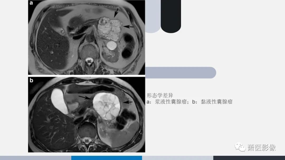 【PPT】常见胰腺囊性肿瘤-12