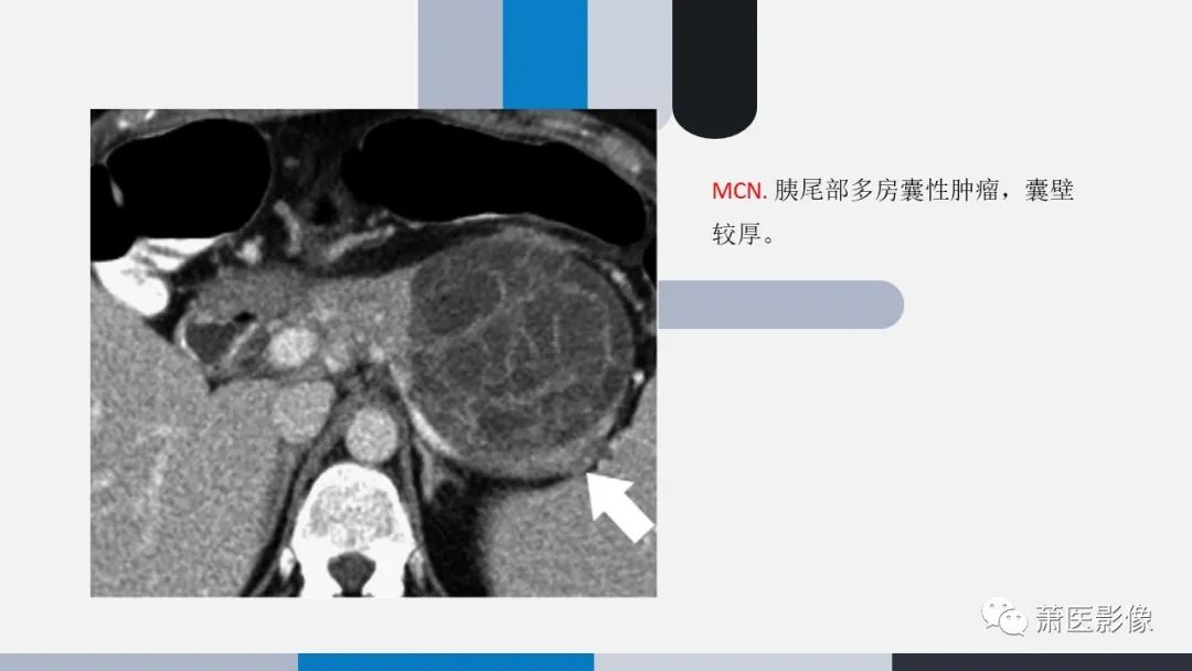 【PPT】常见胰腺囊性肿瘤-10