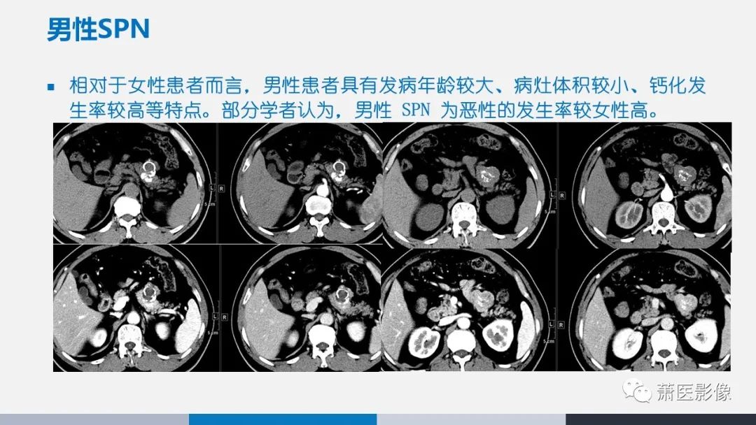 【PPT】常见胰腺囊性肿瘤-33