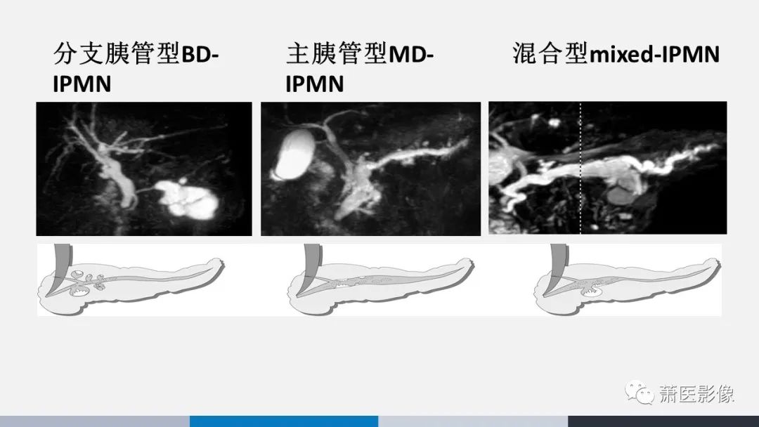 【PPT】常见胰腺囊性肿瘤-18