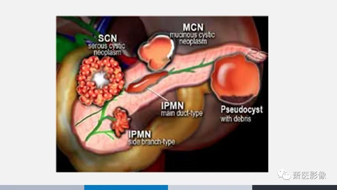 【PPT】常见胰腺囊性肿瘤-36