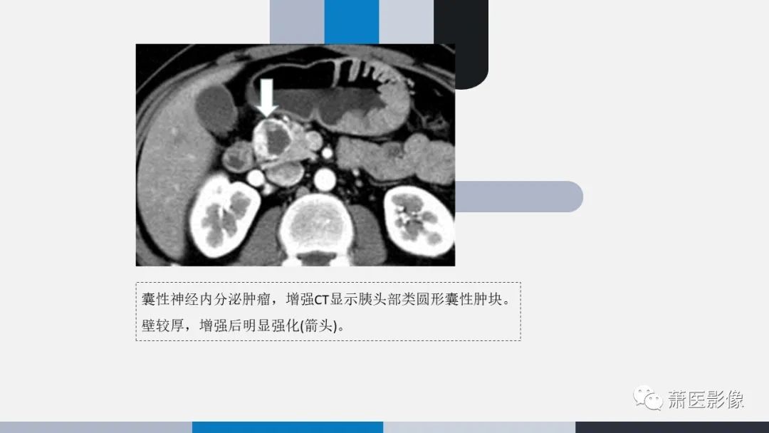 【PPT】常见胰腺囊性肿瘤-43