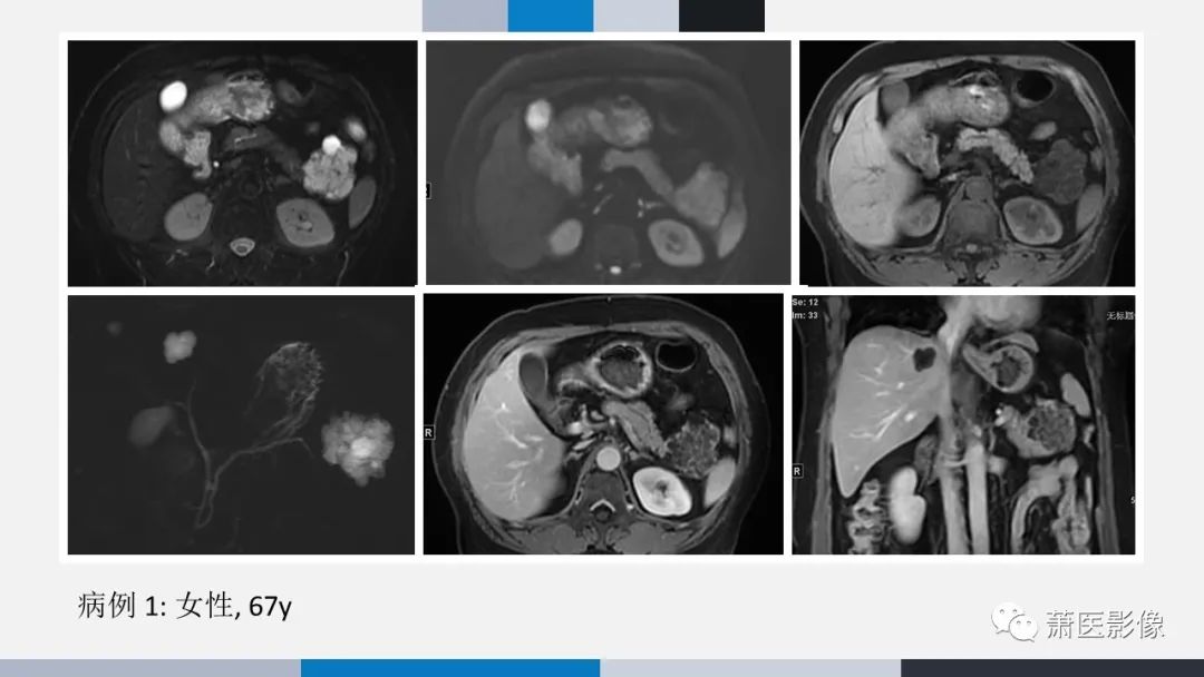 【PPT】常见胰腺囊性肿瘤-45