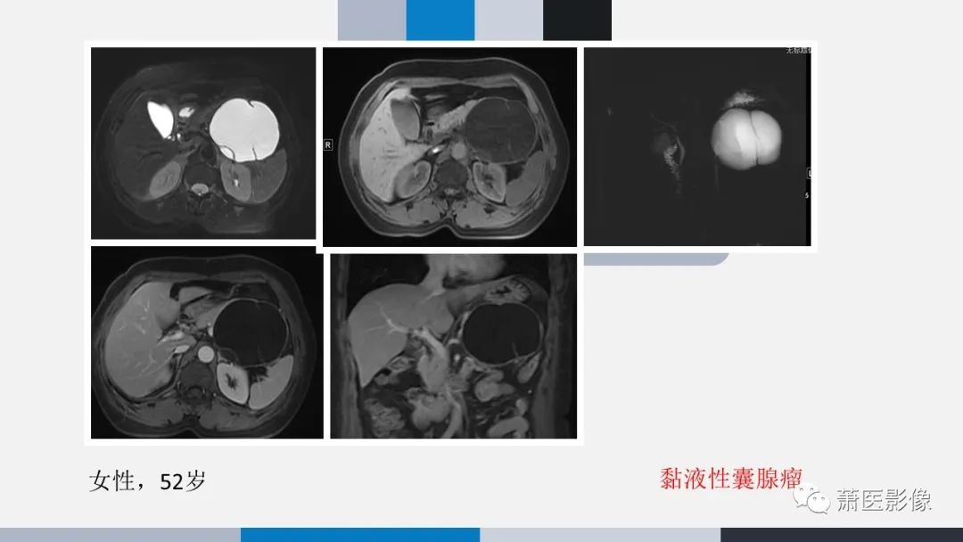 【PPT】常见胰腺囊性肿瘤-50