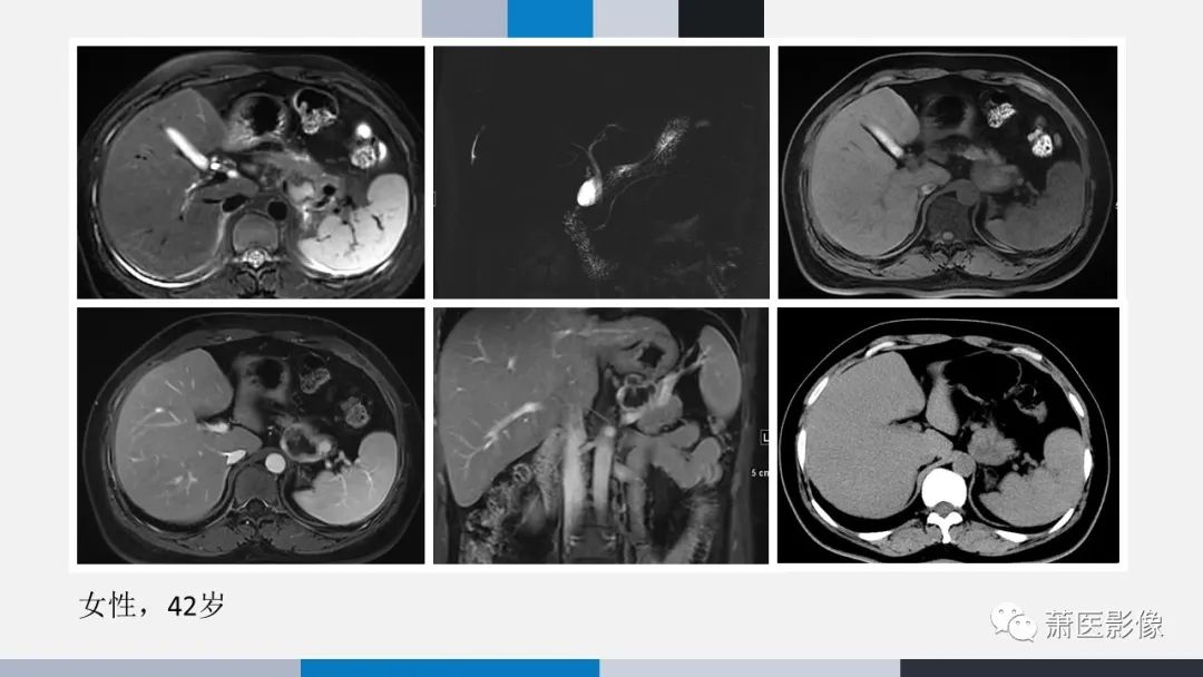 【PPT】常见胰腺囊性肿瘤-56