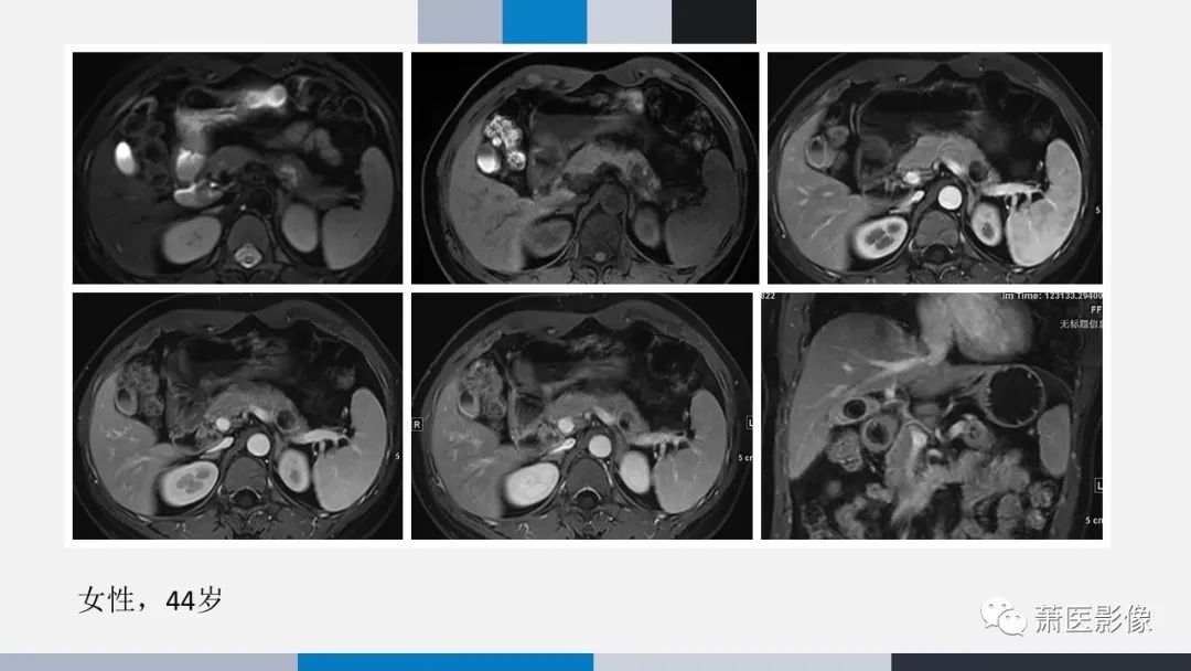 【PPT】常见胰腺囊性肿瘤-54