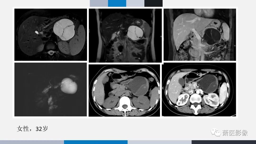 【PPT】常见胰腺囊性肿瘤-48