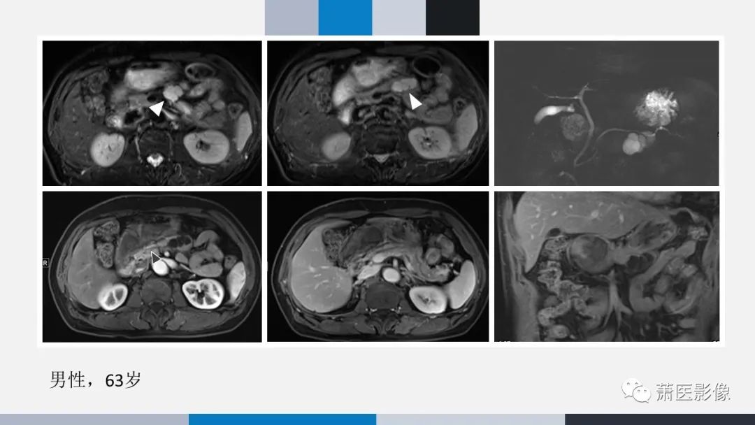 【PPT】常见胰腺囊性肿瘤-51