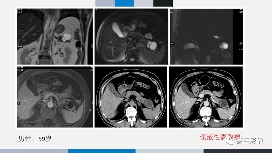 【PPT】常见胰腺囊性肿瘤-47