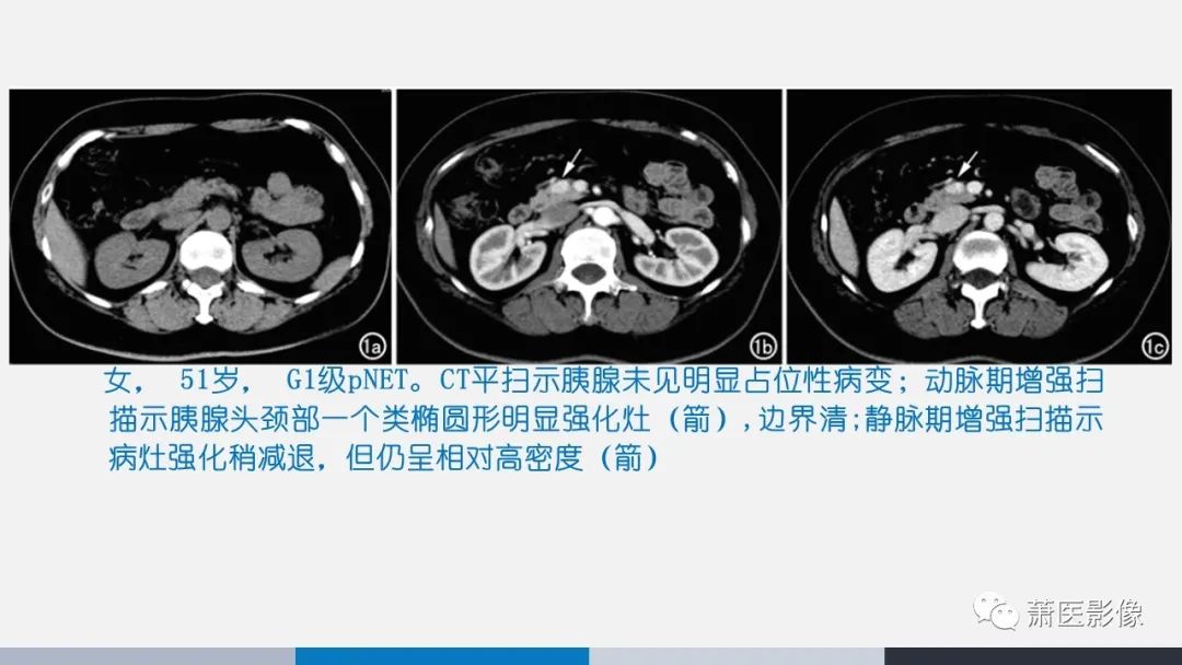 【PPT】常见胰腺囊性肿瘤-40