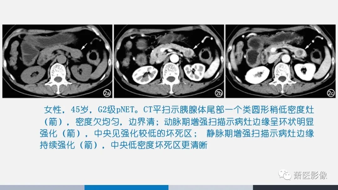 【PPT】常见胰腺囊性肿瘤-41