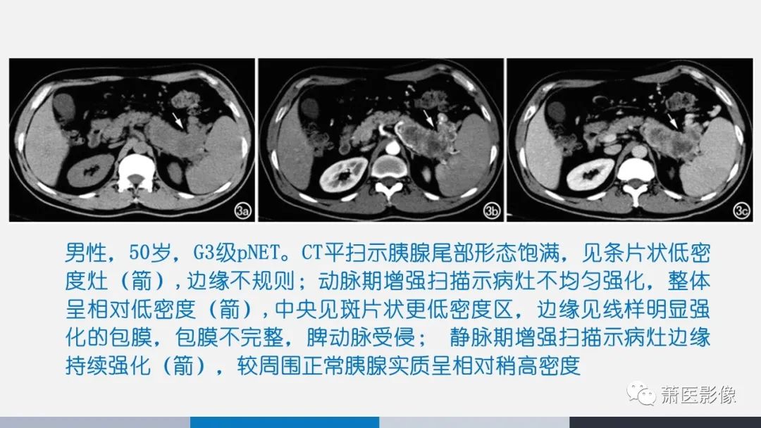 【PPT】常见胰腺囊性肿瘤-42