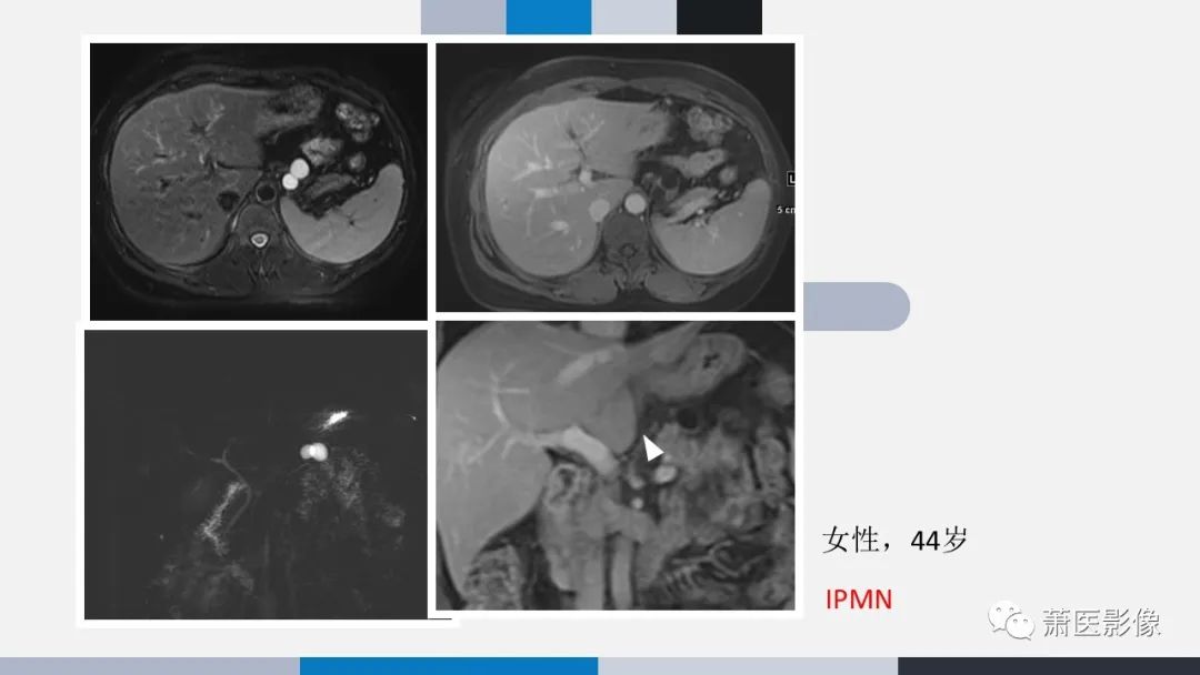 【PPT】常见胰腺囊性肿瘤-53