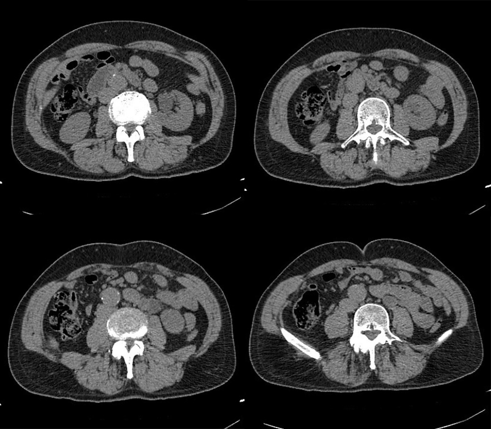 【病例】容易误诊为肾囊肿的肾盏憩室1例CT影像-2