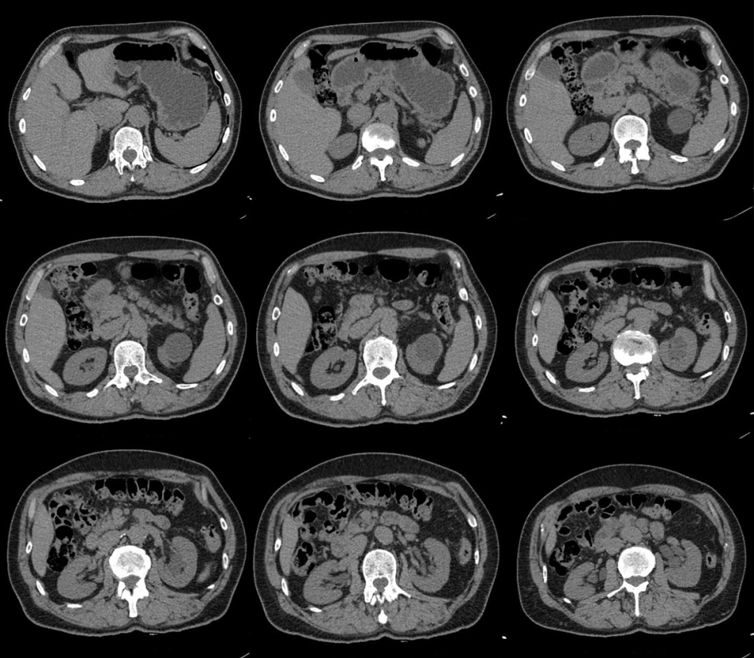 【病例】容易误诊为肾囊肿的肾盏憩室1例CT影像-1