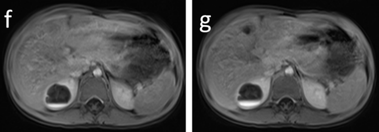 【病例】容易误诊为肾囊肿的肾盏憩室1例CT影像-15