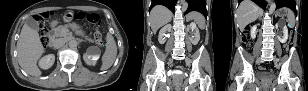 【病例】容易误诊为肾囊肿的肾盏憩室1例CT影像-8